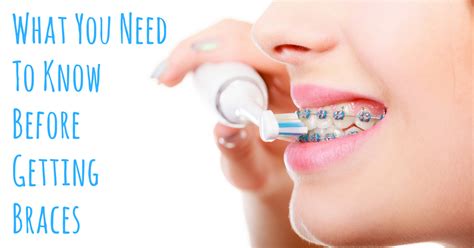4 Things You Need to Know Before Getting Braces in the .